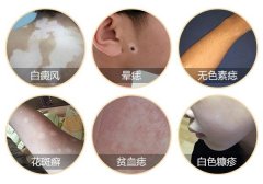 昆明白癜风医院：北京专家疑难型白癜风评估《精准医学项目》公益援助项目